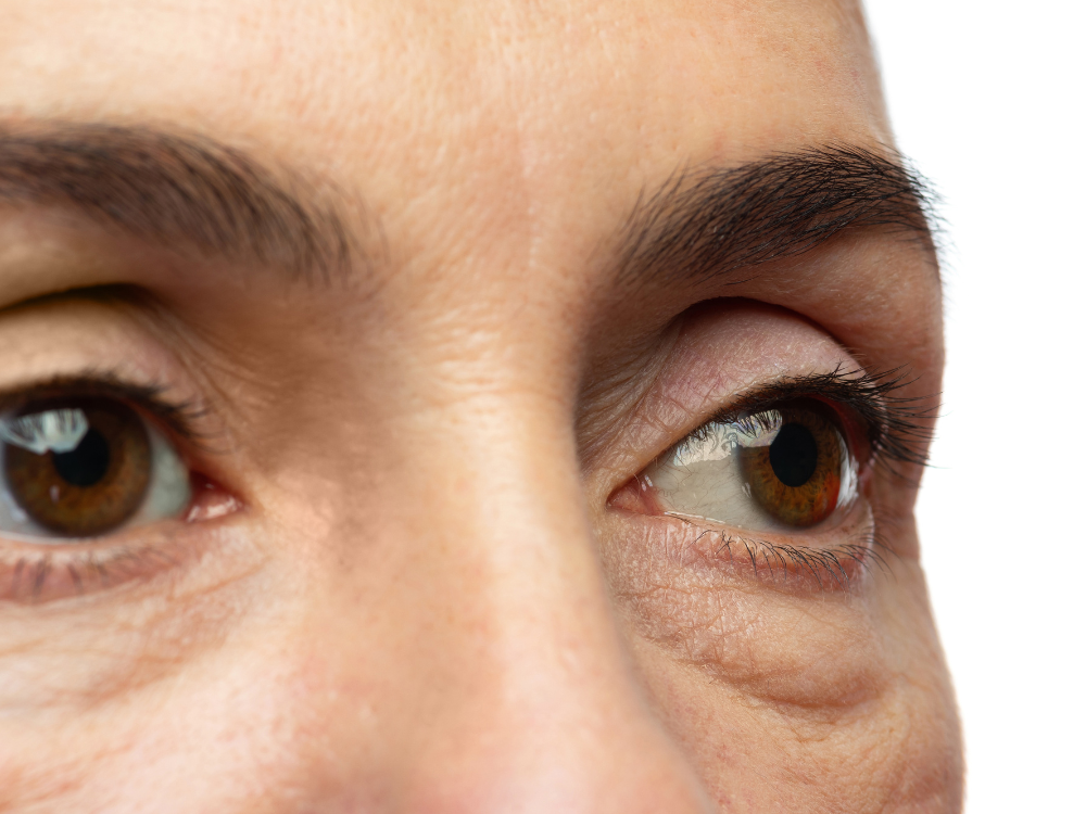 How to Treat Dark Circles and Puffiness