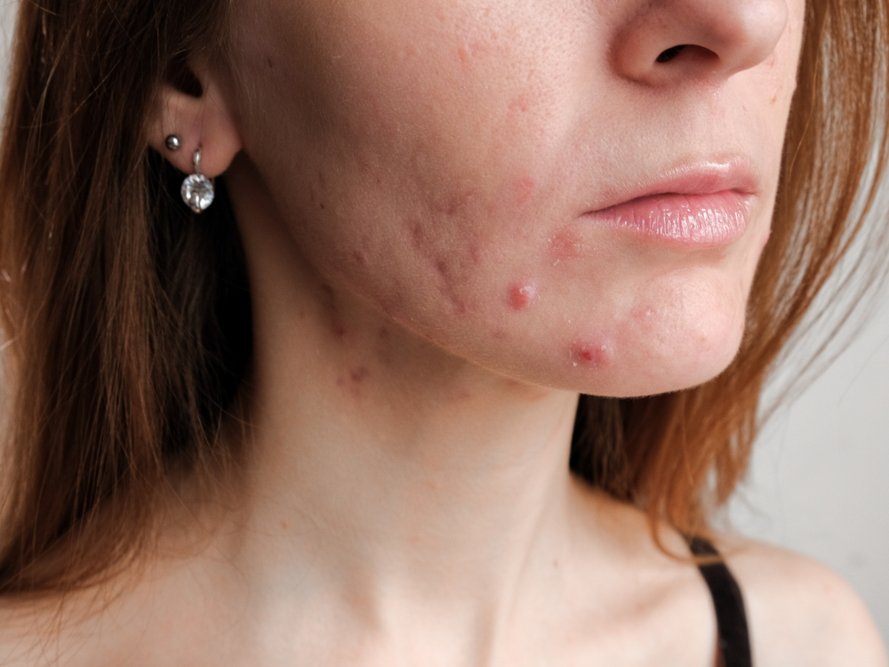 Spironolactone for Hormonal Acne