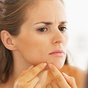 Acne Treatments