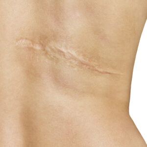 Scar Revision