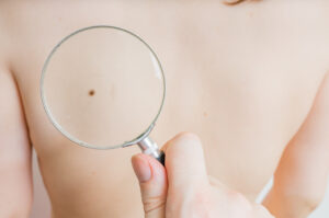 birthmarks