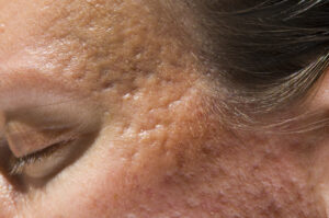 acne scars