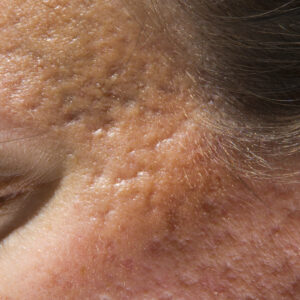 Acne Scars