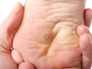 warts on foot