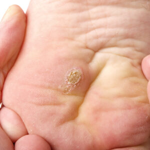 Wart Removal
