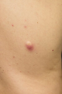 Cysts on skin