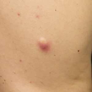 Cyst Removal