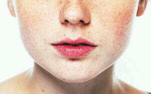 sun damage skin