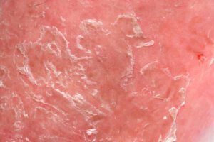 Psoriasis Skin