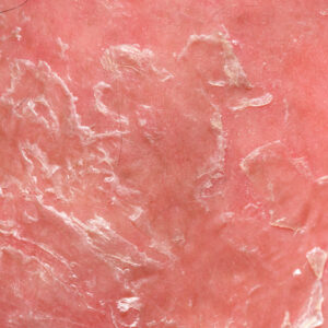 Psoriasis