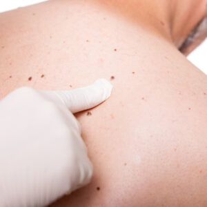 Mole Removal