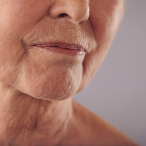 Wrinkle Treatments