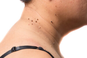 skin tag on neck