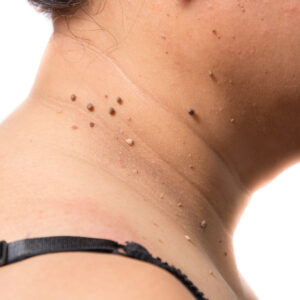 Skin Tag Removal