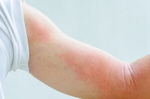 hives