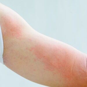 Hives