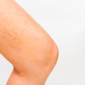 Sclerotherapy