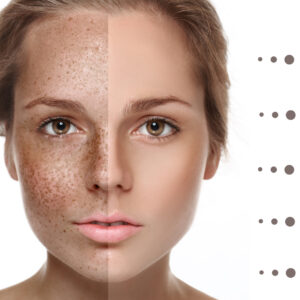 Laser Treatments