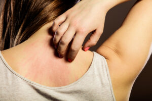 dry skin