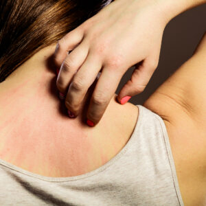 Dry Skin