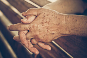 brown spots on hands