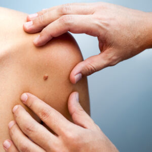 Birthmark Treatments