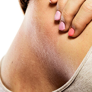 Dermatitis