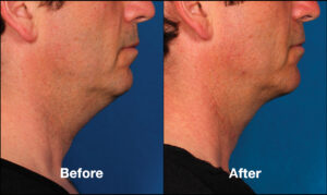 double chin kybella