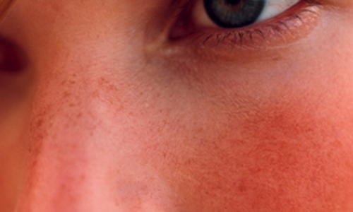 Photo of a facial redness