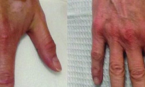 Before and after photos of a person's hand
