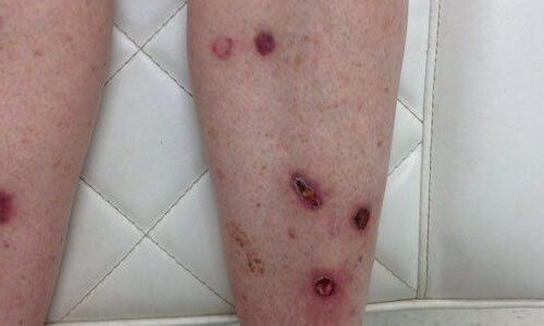 Photo of skin cancer spots on a patient's legs