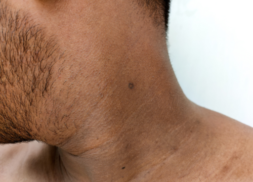 Treatment of horizontal neck lines
