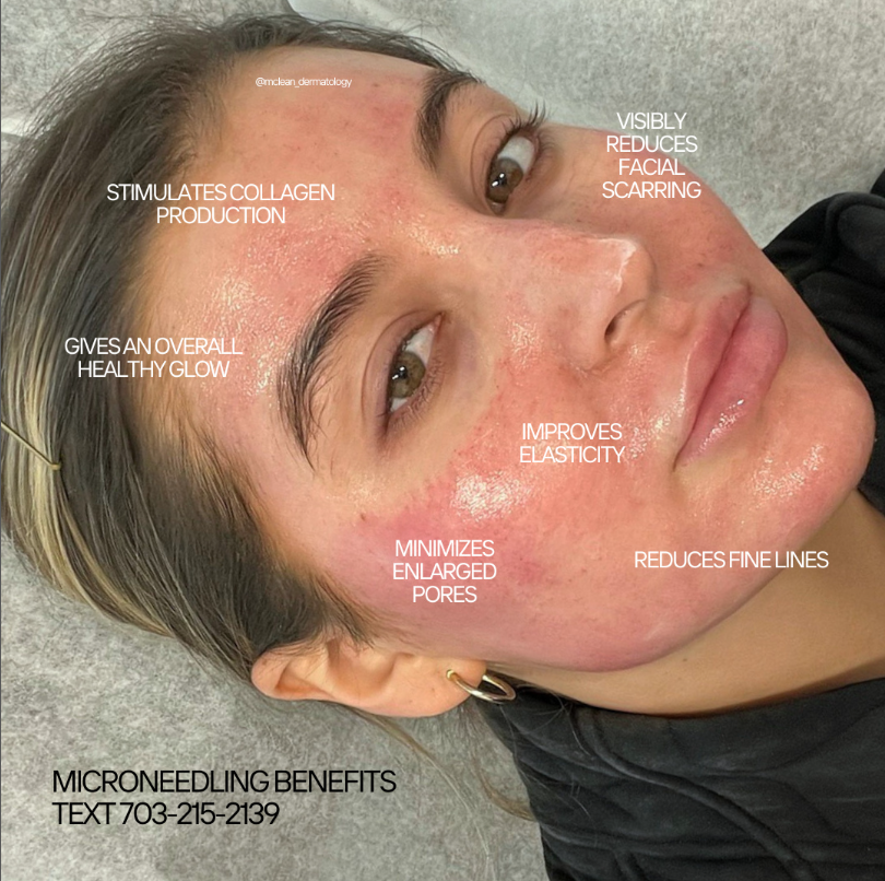 Microneedling Gallery