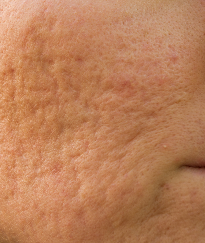 Photo of acne scars on a person's cheek