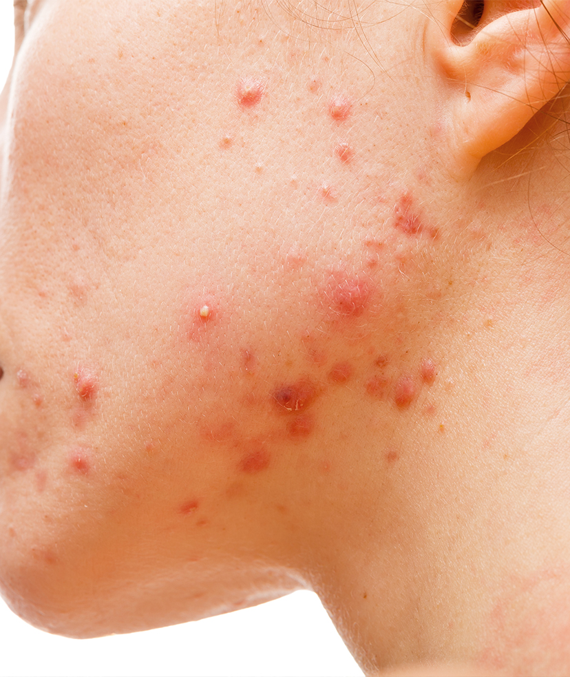 Photo of acne on a woman's face
