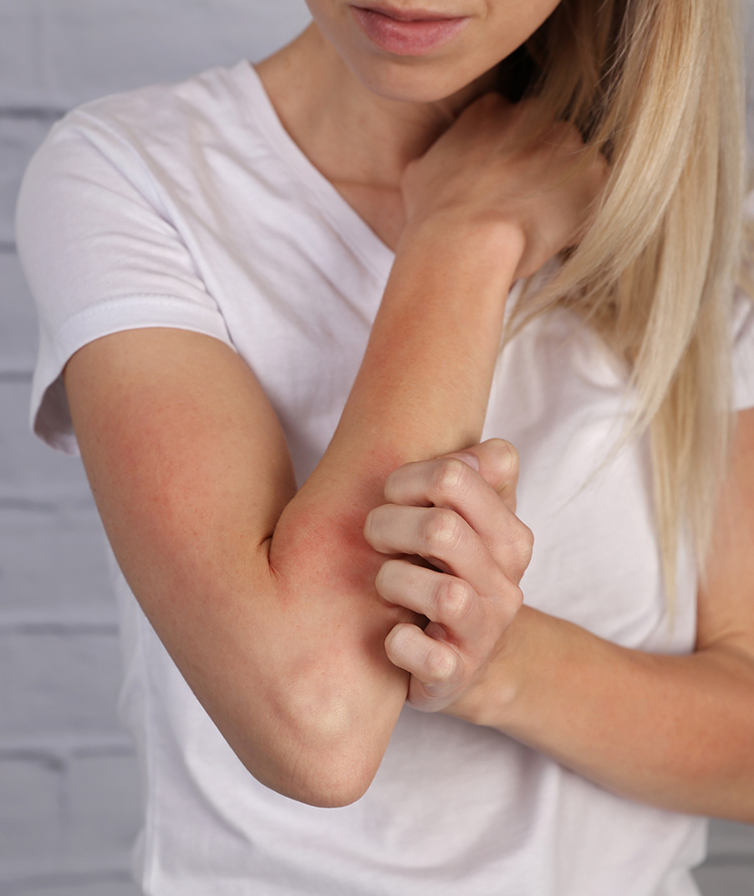 Photo of a woman scratching a rash on her arm