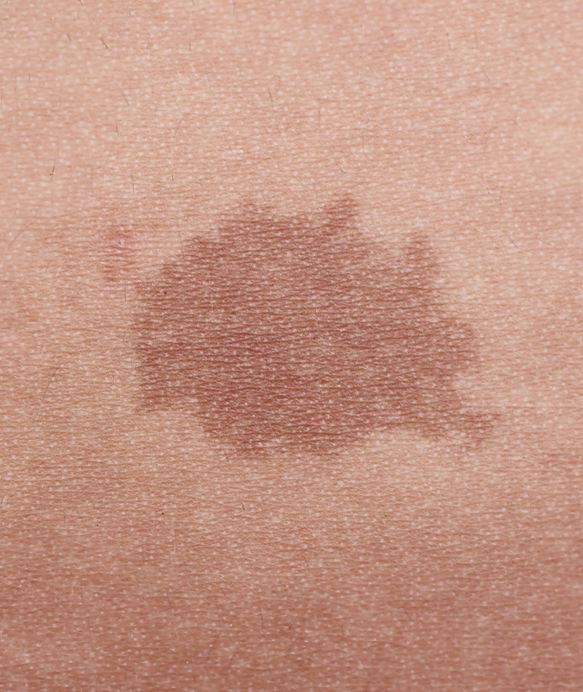 Brown Spots Treatment  McLean & Potomac Dermatology