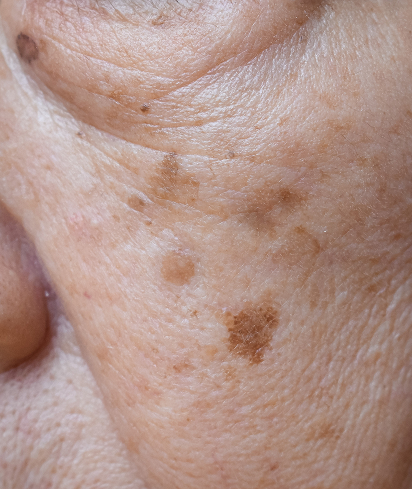 Photo of brown spots on an older woman's face