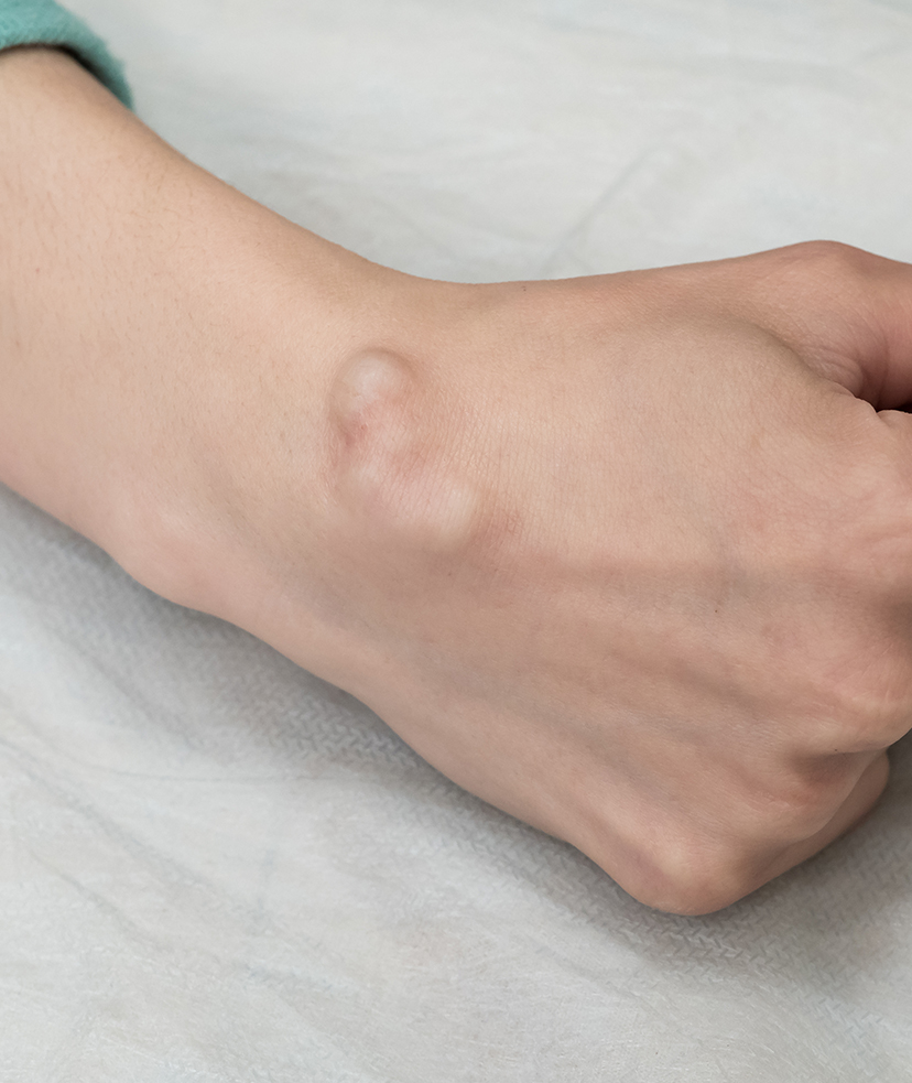 Photo of a cyst on a woman's hand