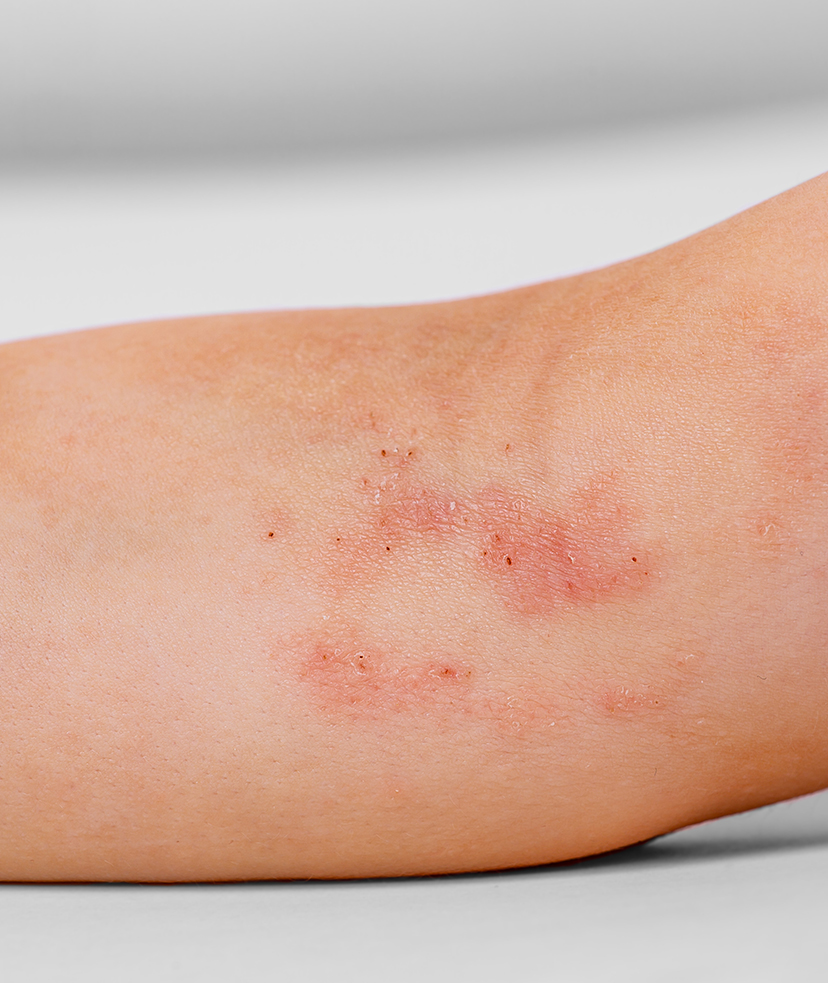 Photo of a dermatitis rash on a person's arm