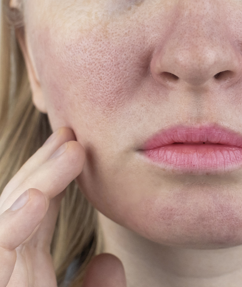 Photo of enlarged pores on a woman's face
