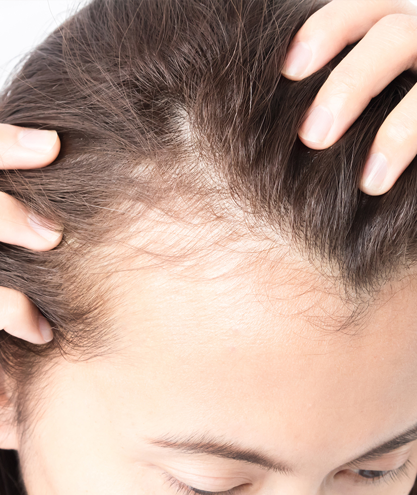 Photo of a woman's receding hairline