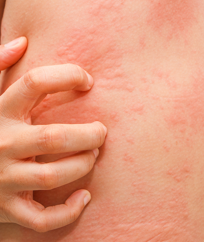 Photo of hives on a person's skin