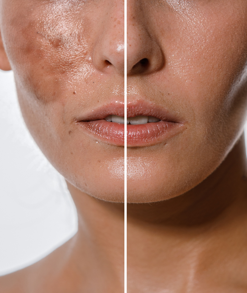 Side-by-side photos of a woman's face with and without hyperpigmentation