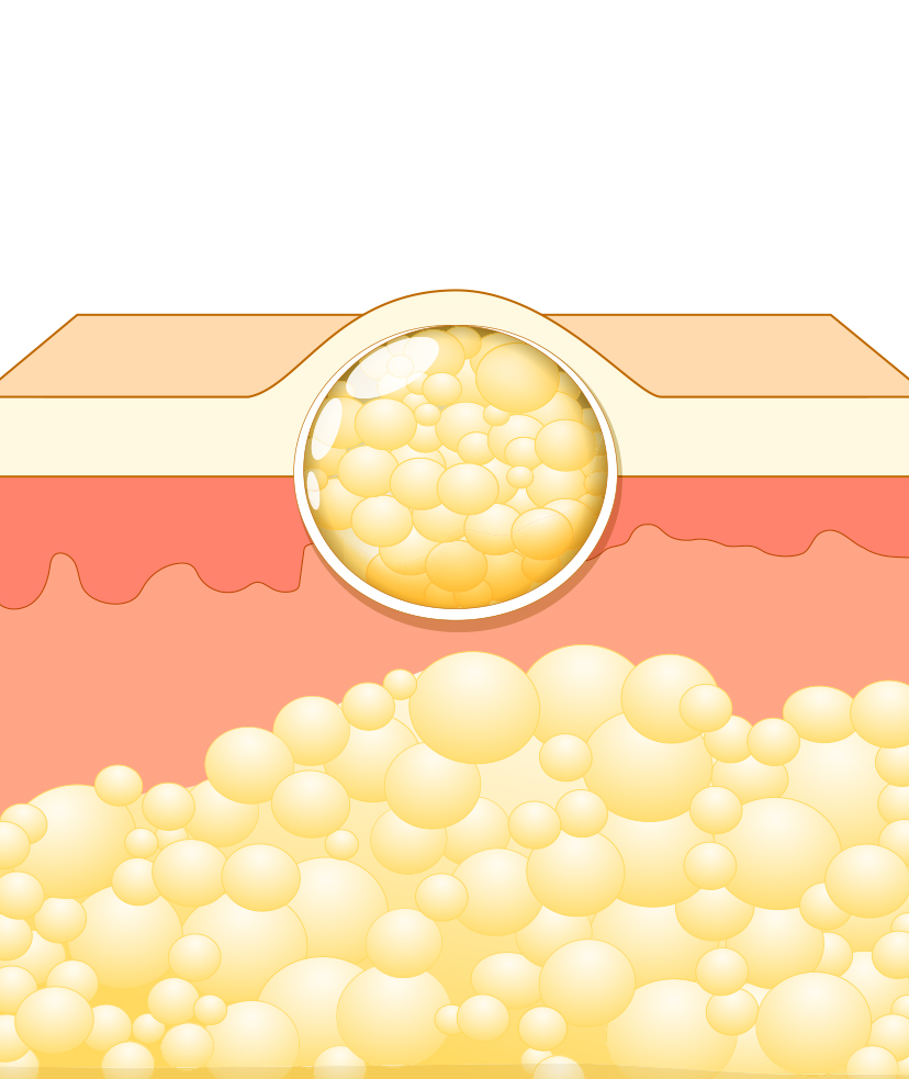 What Is The Difference Between Lipoma And Cancer