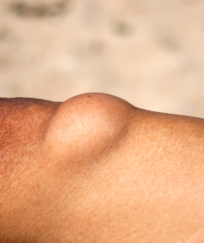 Photo of a lipoma on a person's body