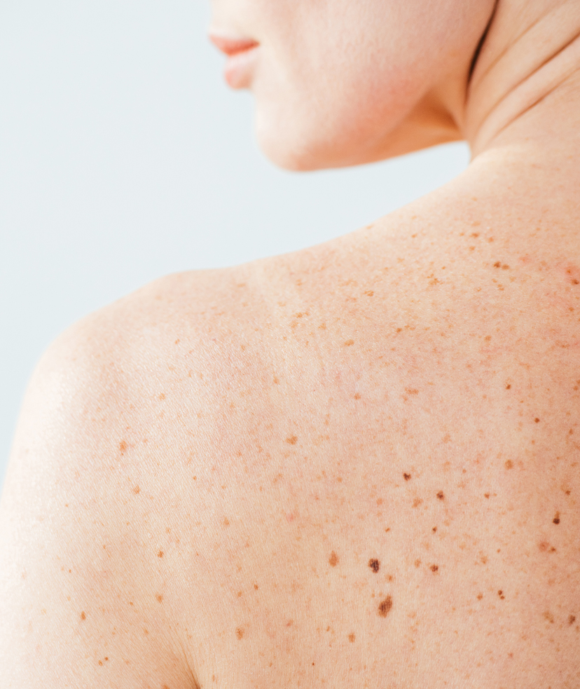 Photo of multiple brown spots on a person's upper back and shoulder