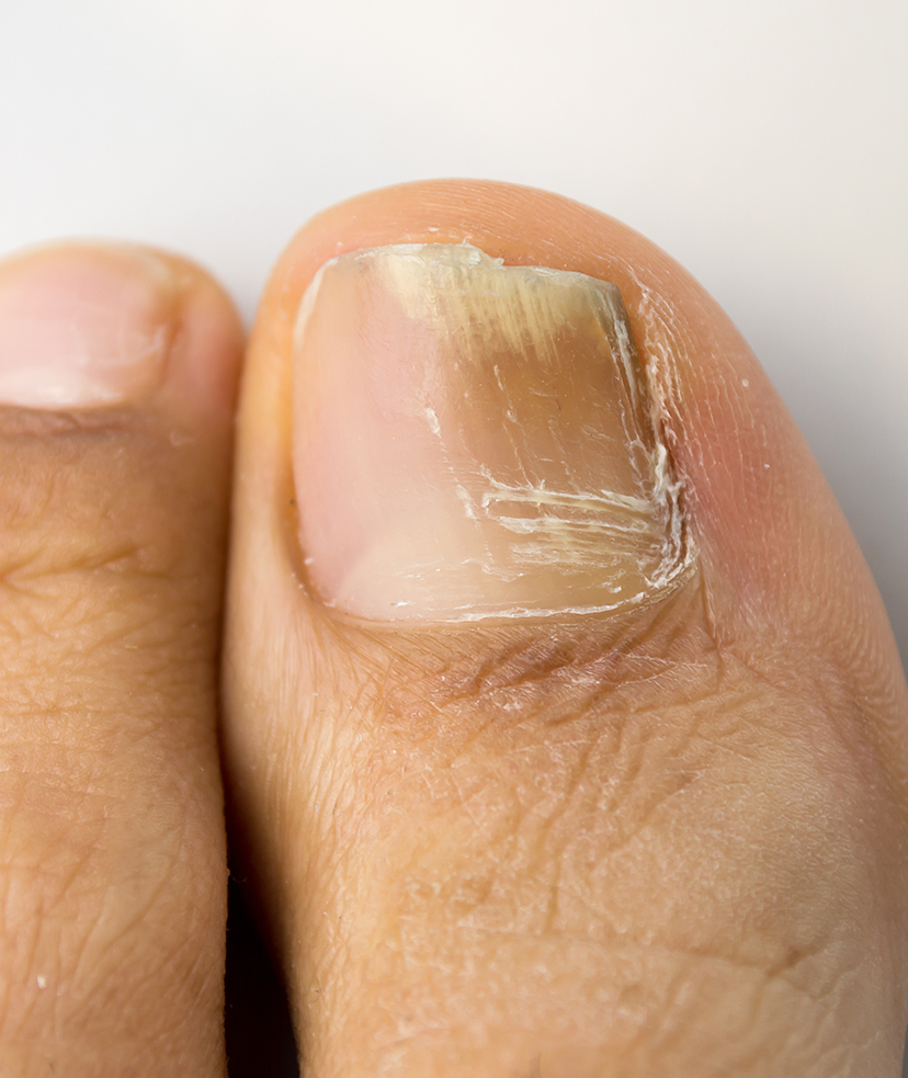 Photo of nail fungus on a big toe