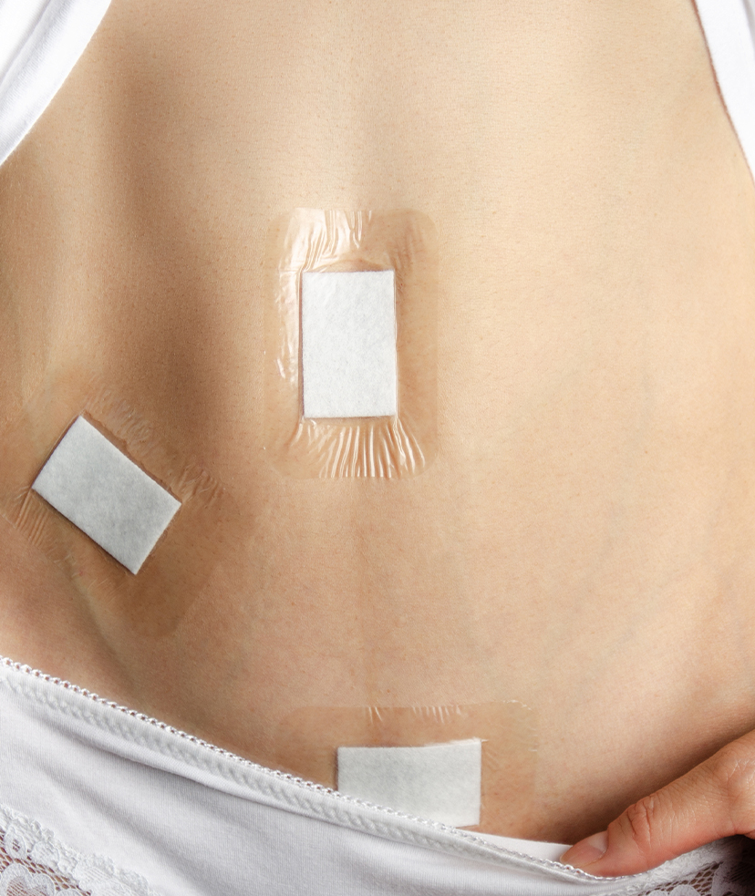 Photo of bandages on a woman's stomach after a piercing removal procedure