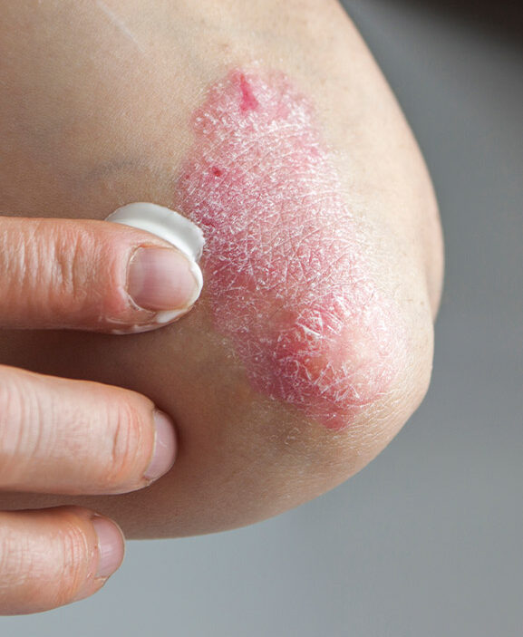 Photo of a psoriasis rash on a person's elbow